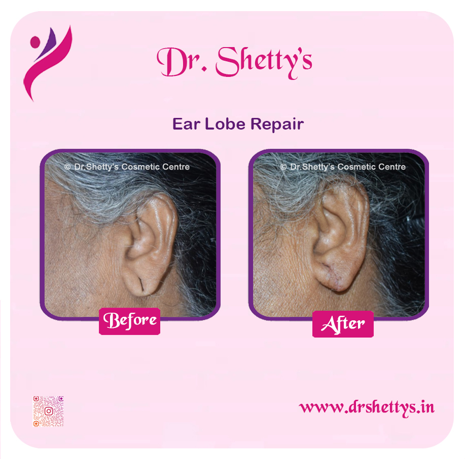 EarLobe 14