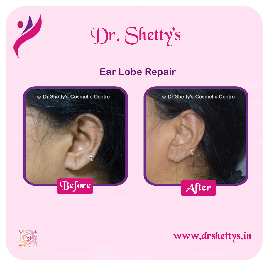 EarLobe 15