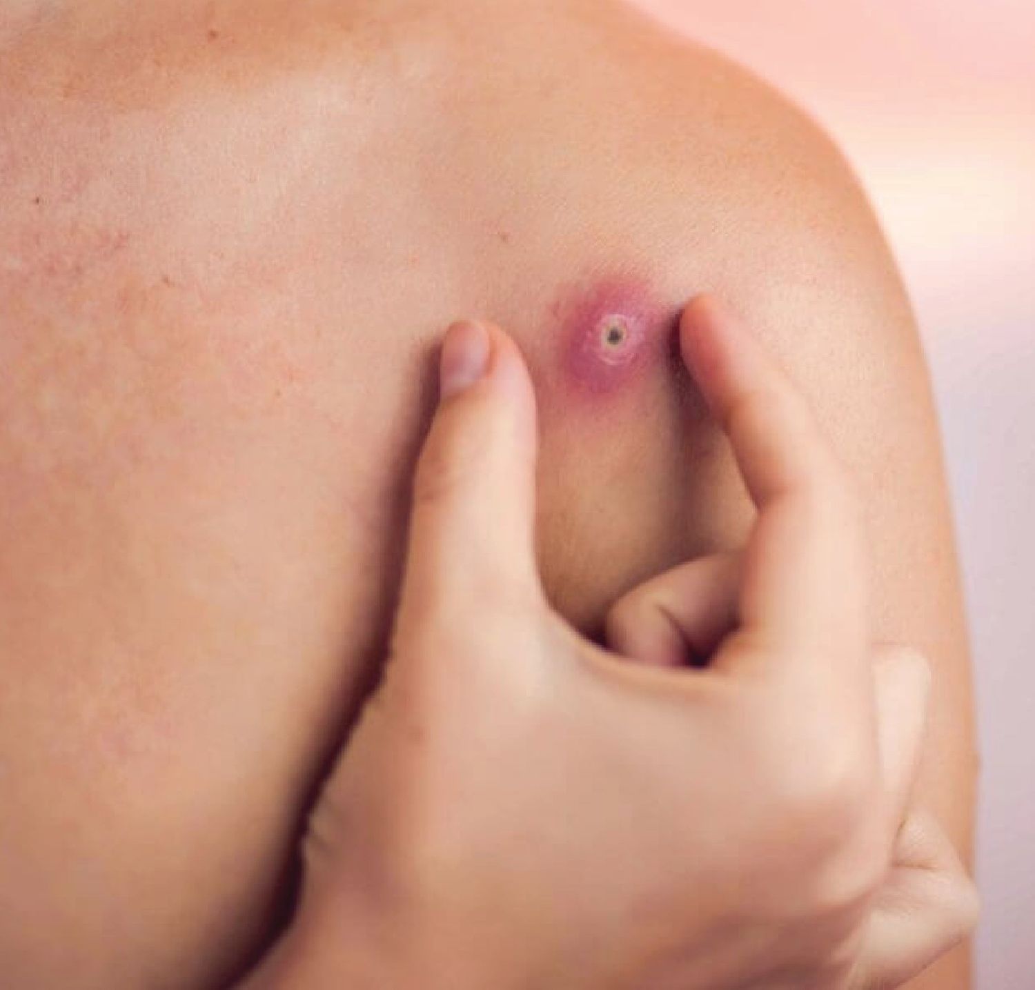 EpidermoidCystRemoval