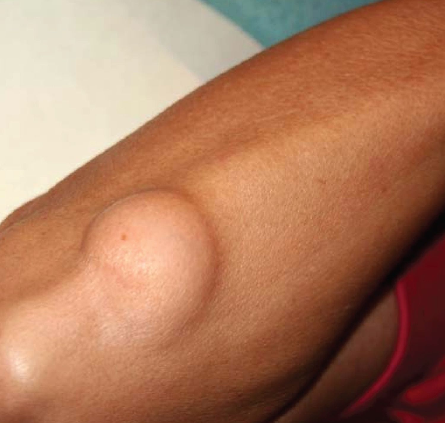 ExcisionSurgicalRemoval