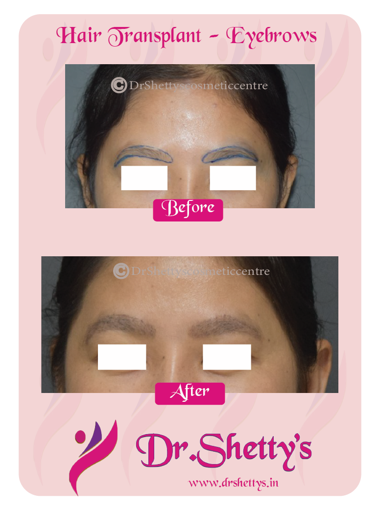 Eyebrow Hair Transplant 7