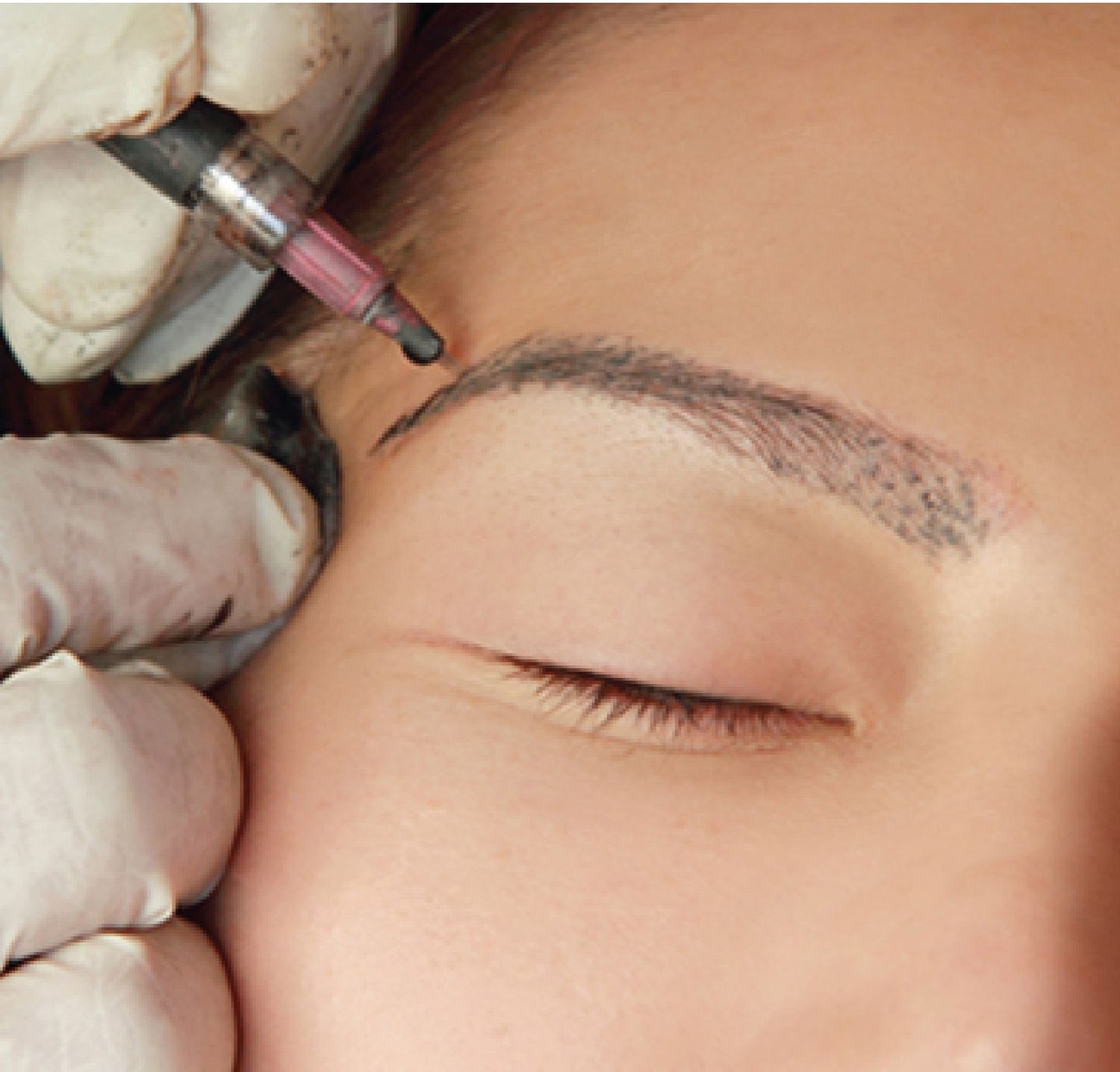 FUE Follicular Unit Extraction 1