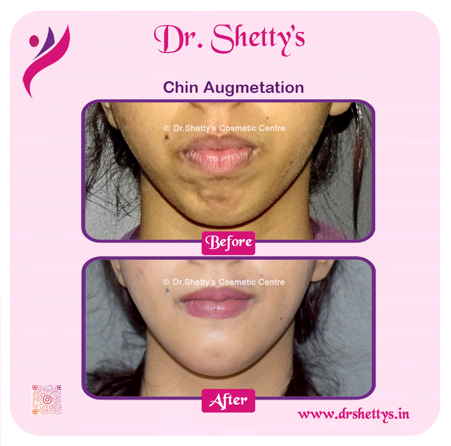 Facial Augmentation 1