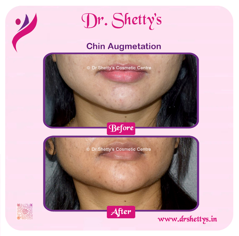 Facial Augmentation 10