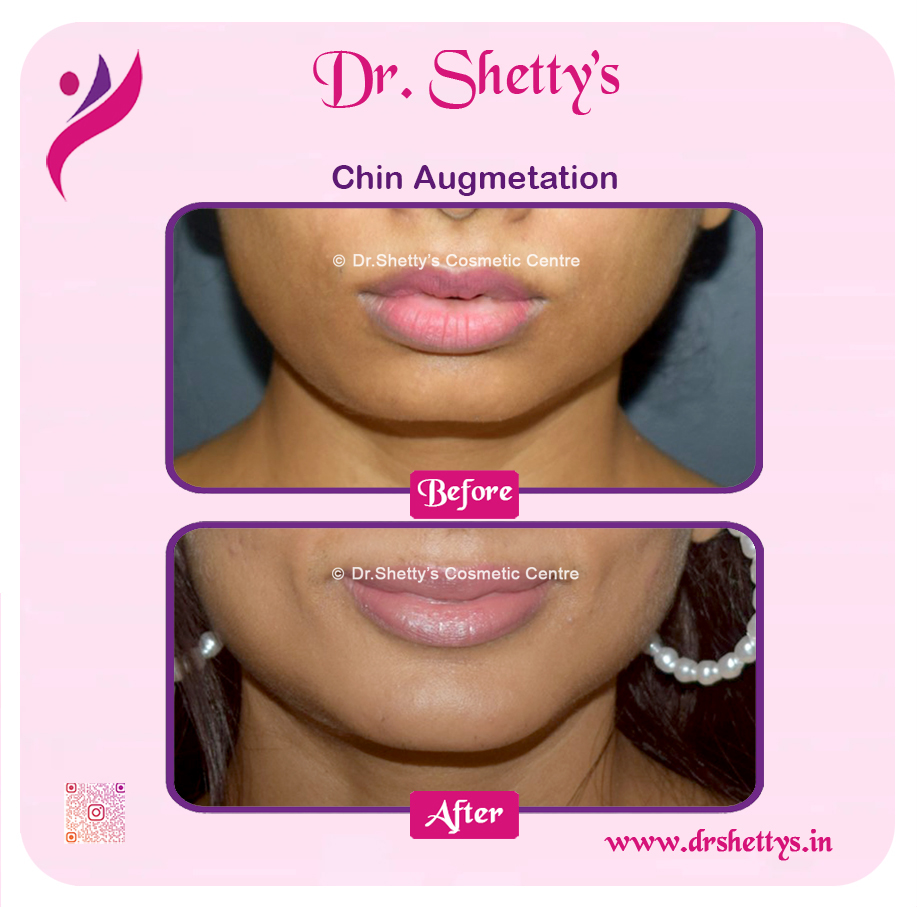 Facial Augmentation 11
