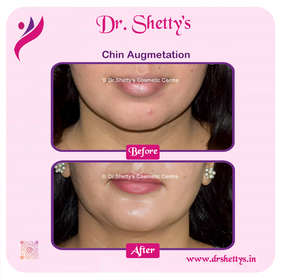 Facial Augmentation 12