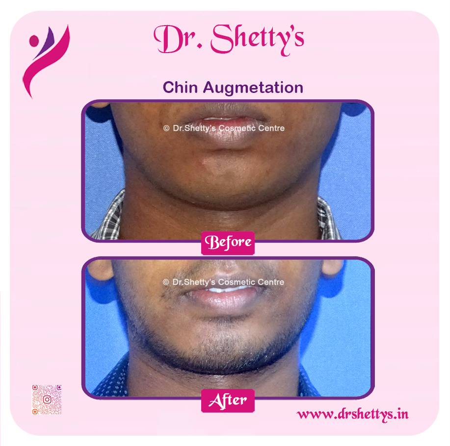 Facial Augmentation 14