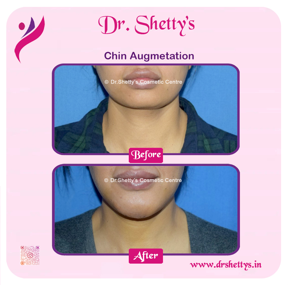 Facial Augmentation 2