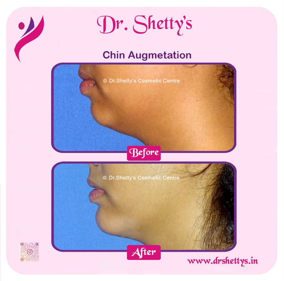 Facial Augmentation 3