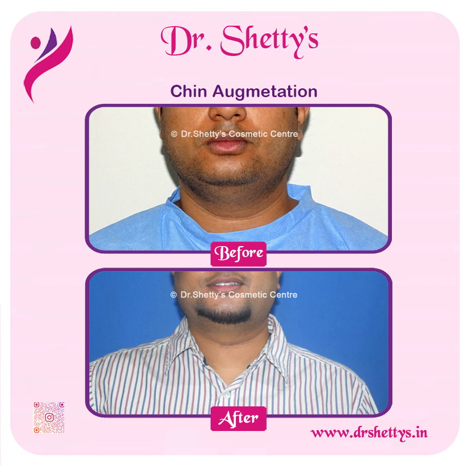 Facial Augmentation 4