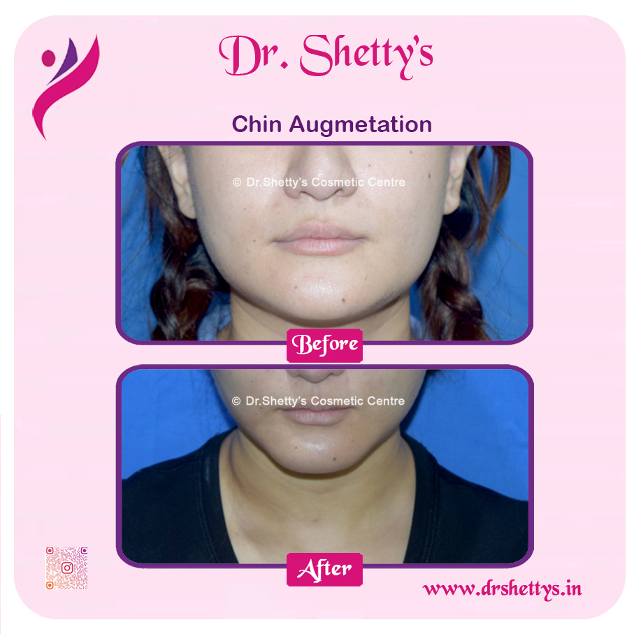 Facial Augmentation 5