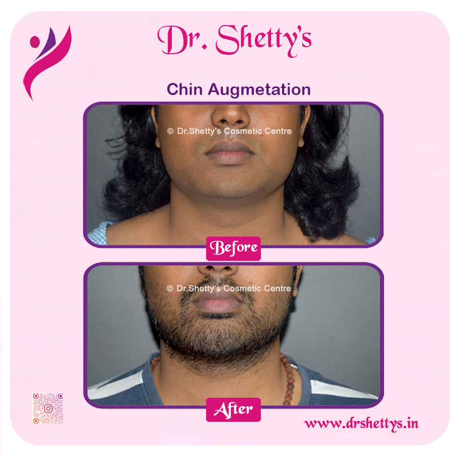 Facial Augmentation 6