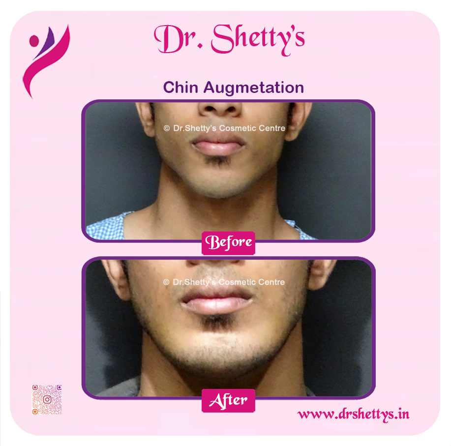 Facial Augmentation 7