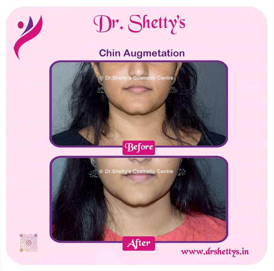 Facial Augmentation 8
