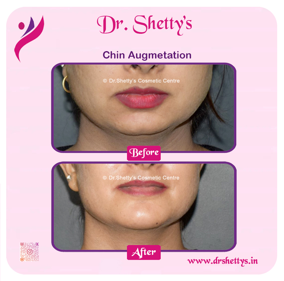 Facial Augmentation 9