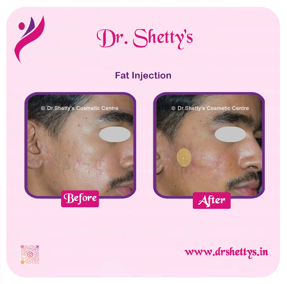 Fat Grafting Surgery 1