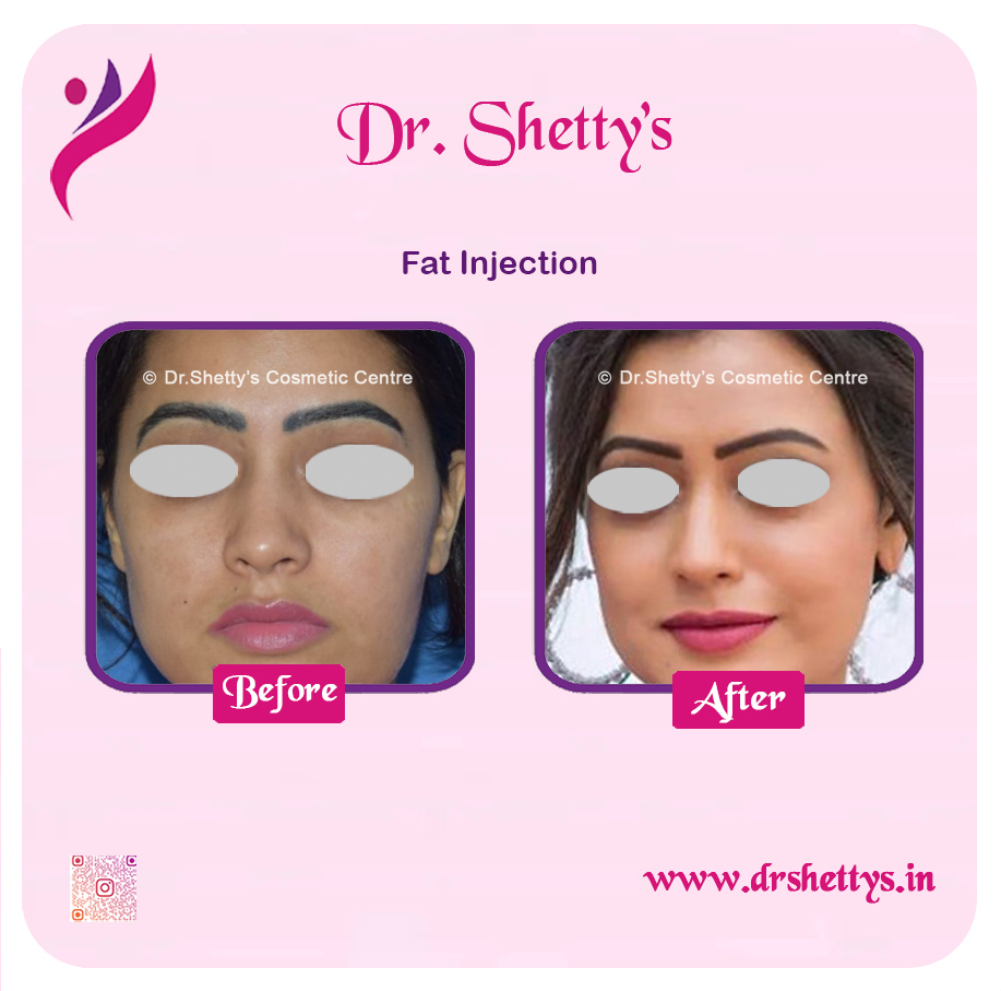 Fat Grafting Surgery 10
