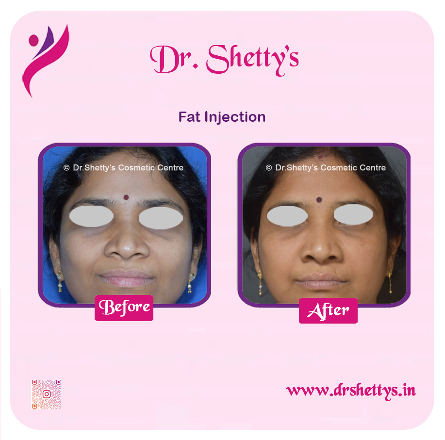 Fat Grafting Surgery 12