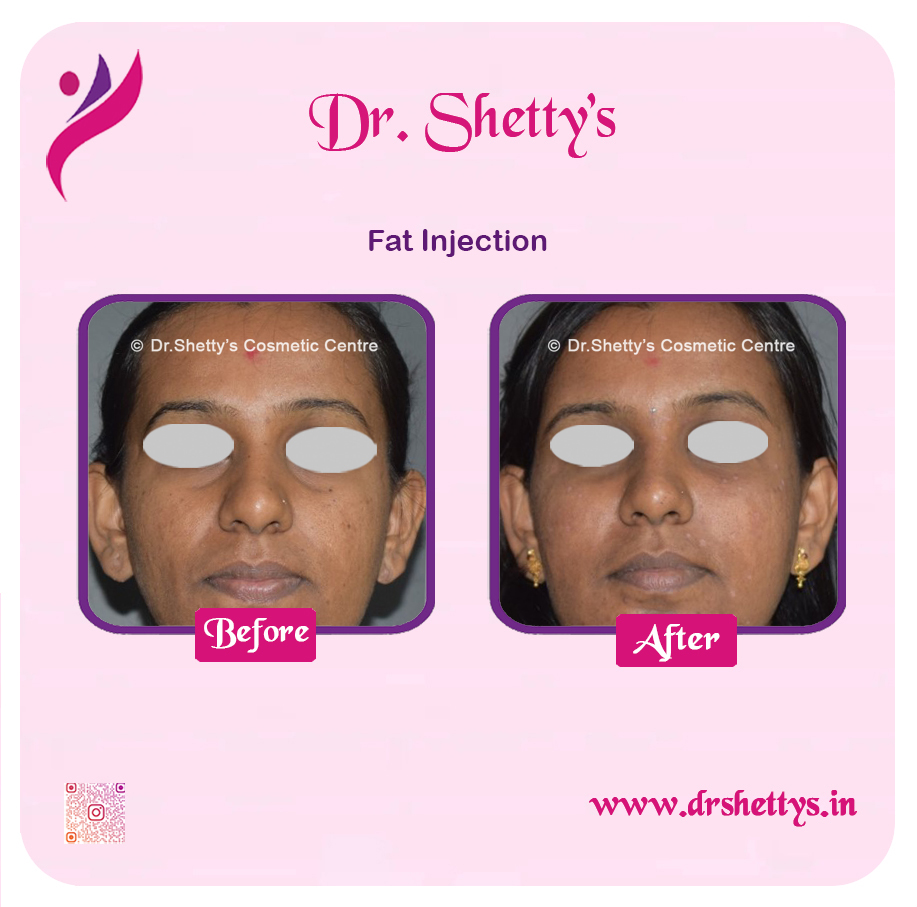 Fat Grafting Surgery 13