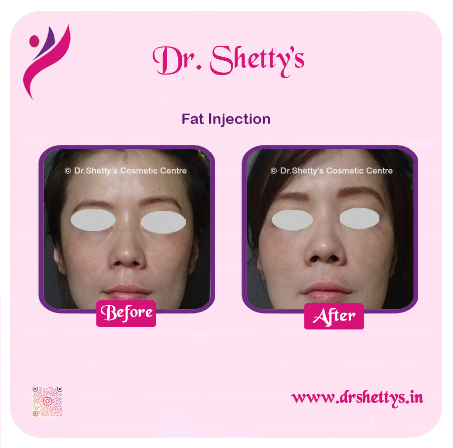 Fat Grafting Surgery 14