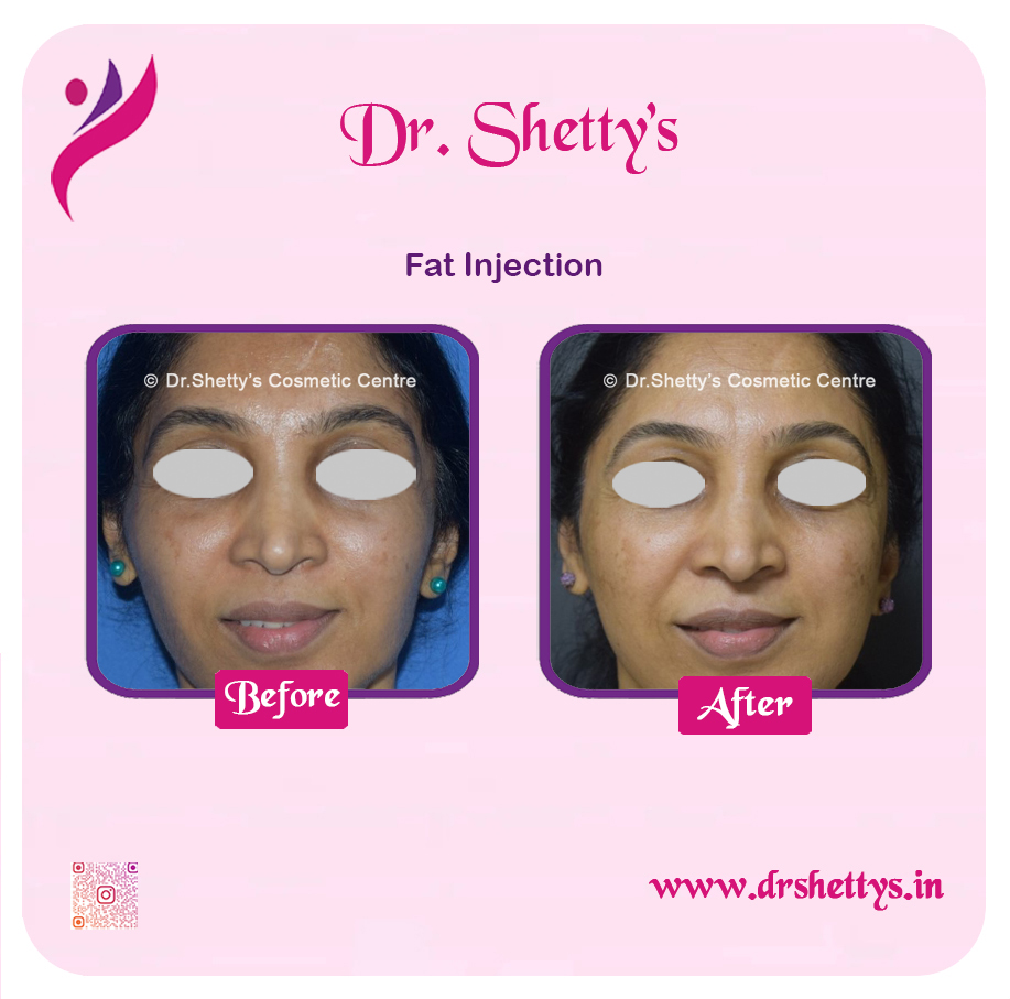 Fat Grafting Surgery 15