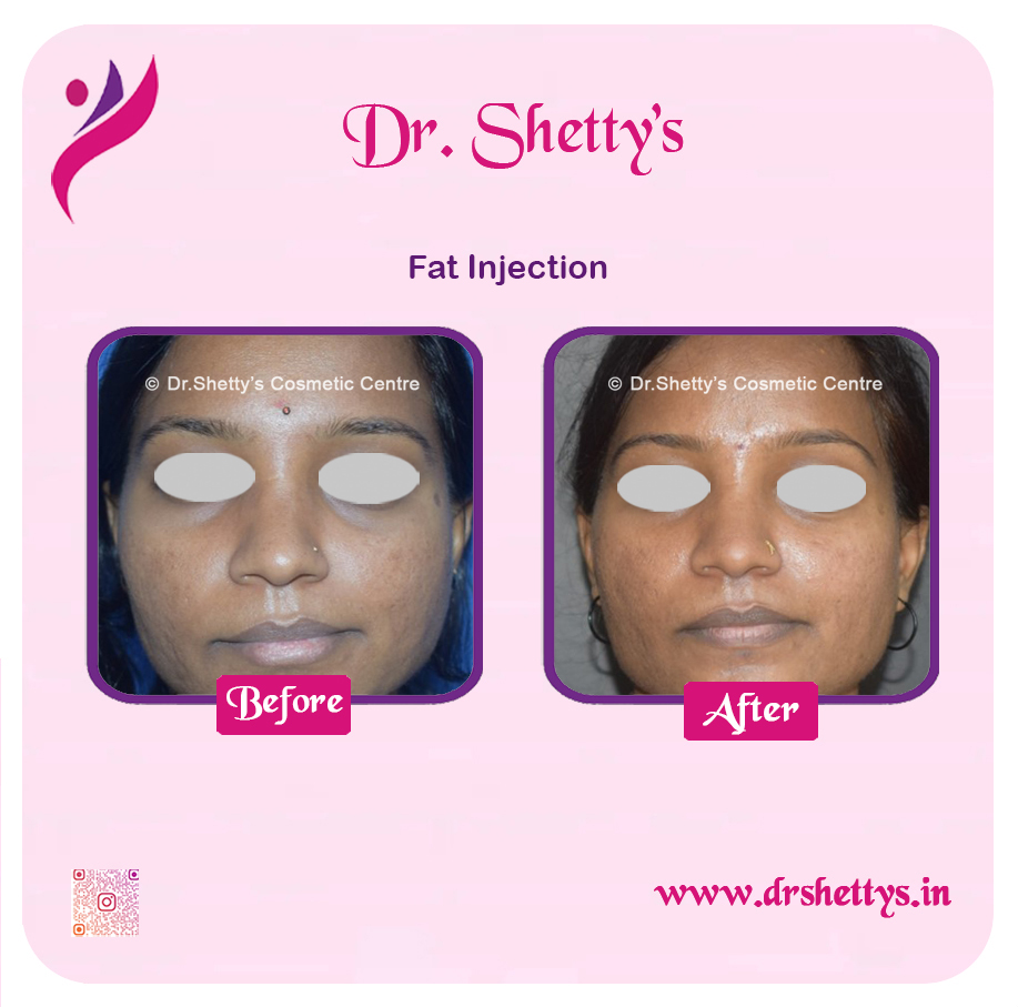 Fat Grafting Surgery 16