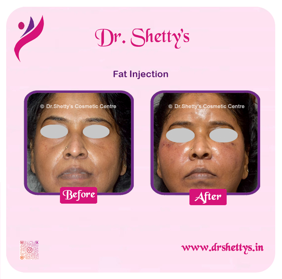 Fat Grafting Surgery 3