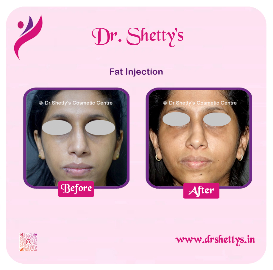 Fat Grafting Surgery 4