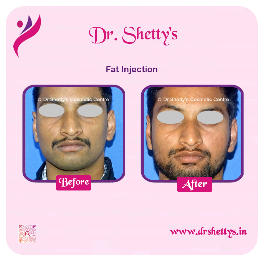 Fat Grafting Surgery 5