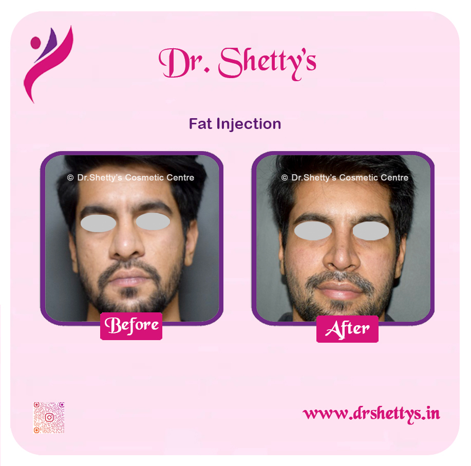 Fat Grafting Surgery 6