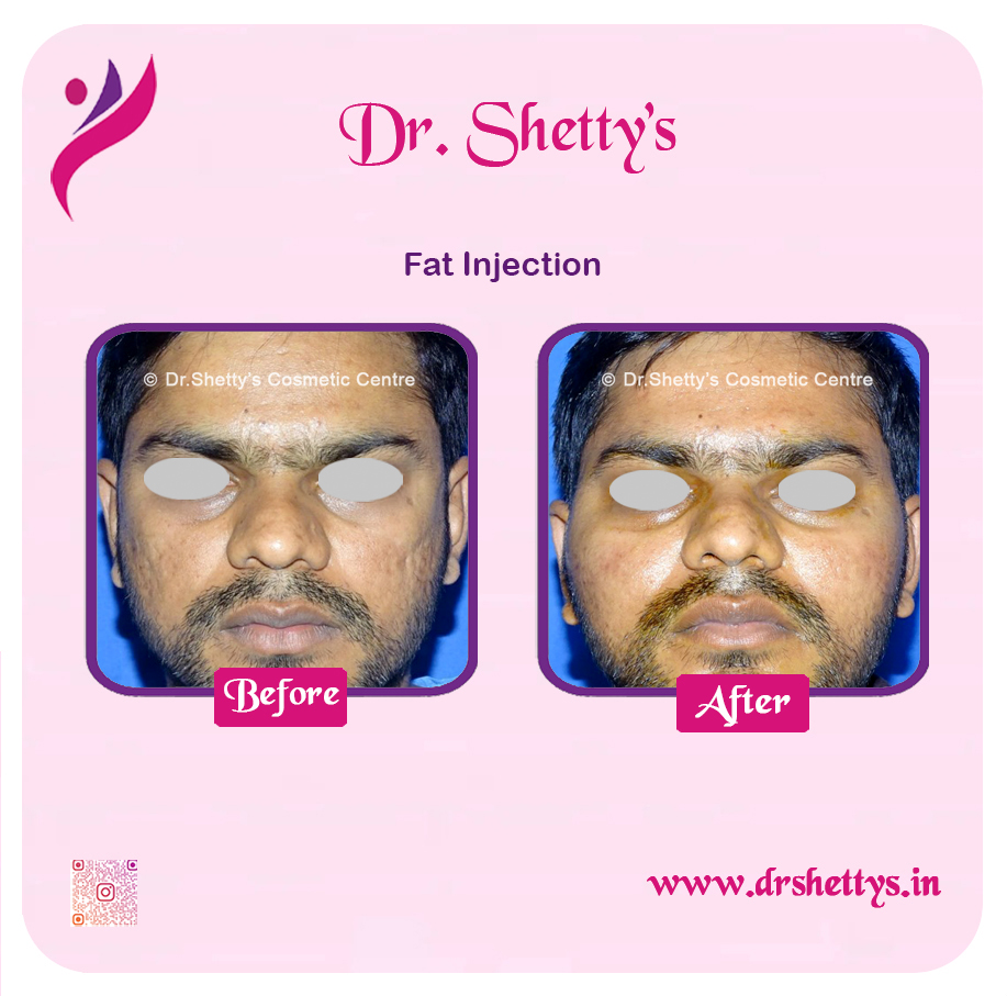 Fat Grafting Surgery 7
