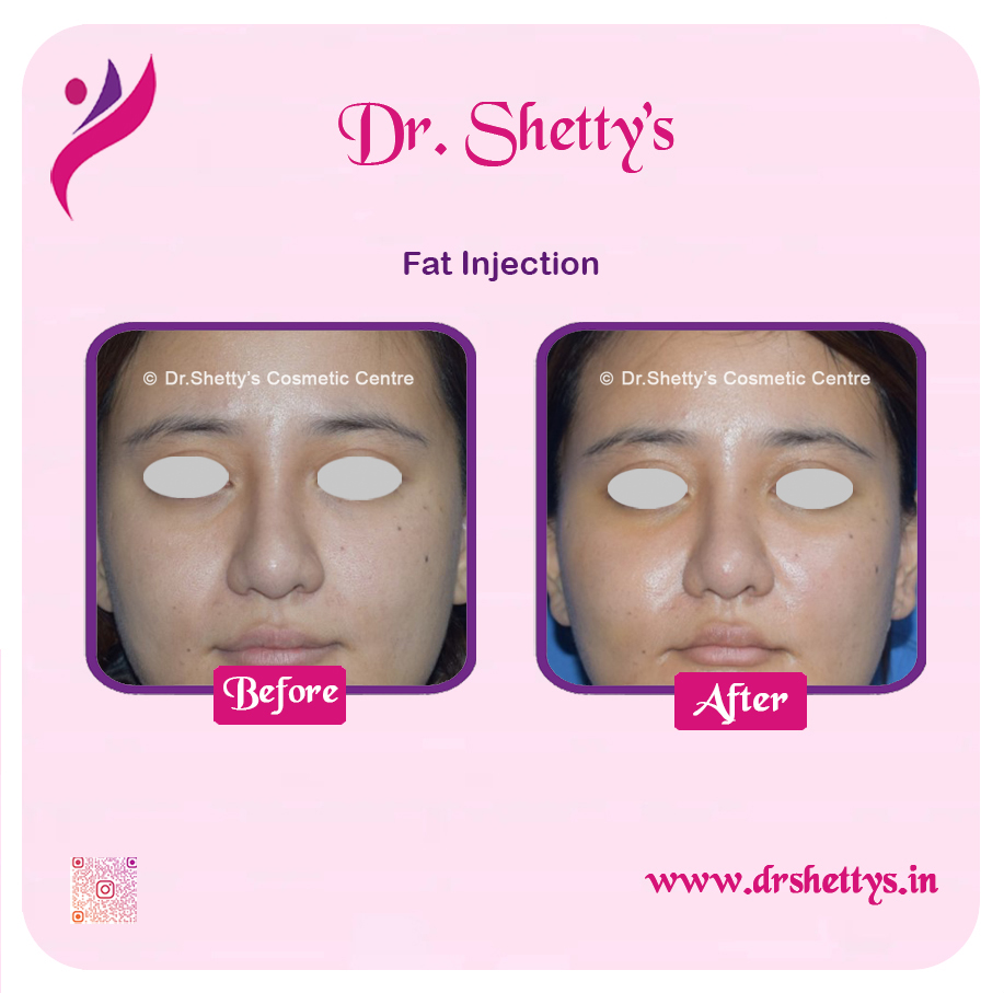 Fat Grafting Surgery 8