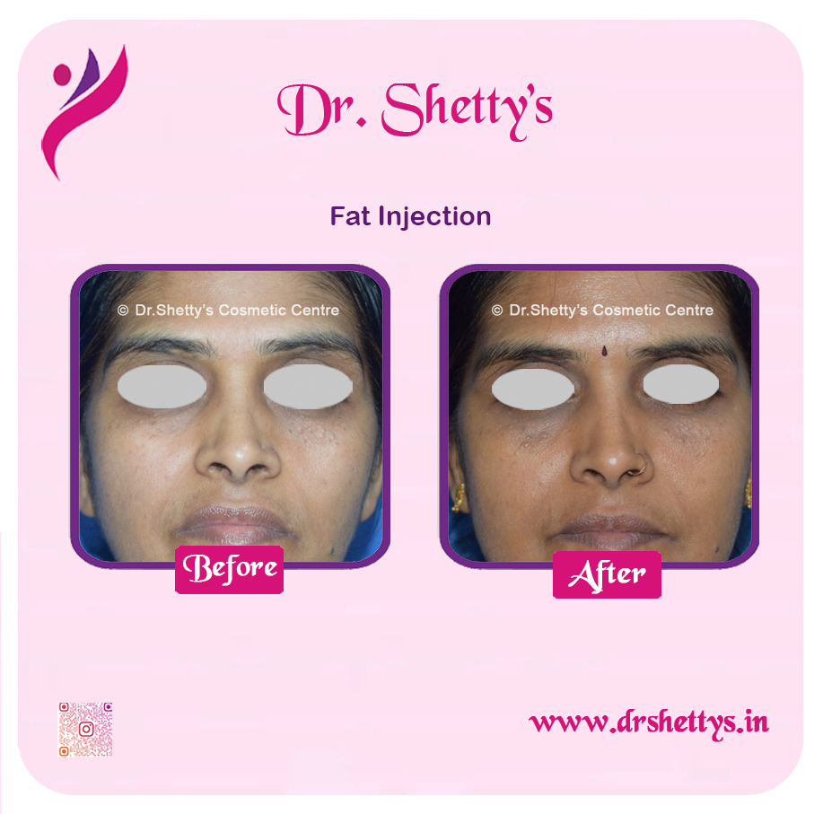Fat Grafting Surgery 9