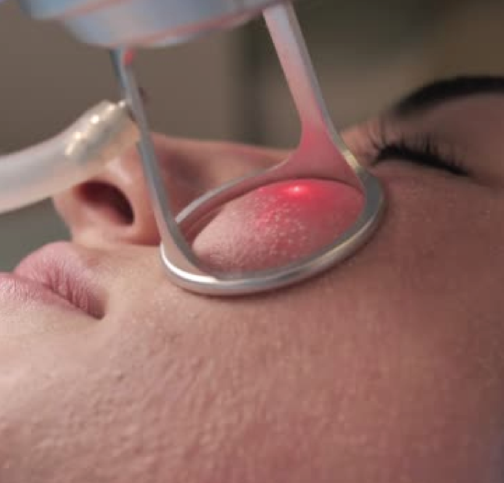 Fractional Laser