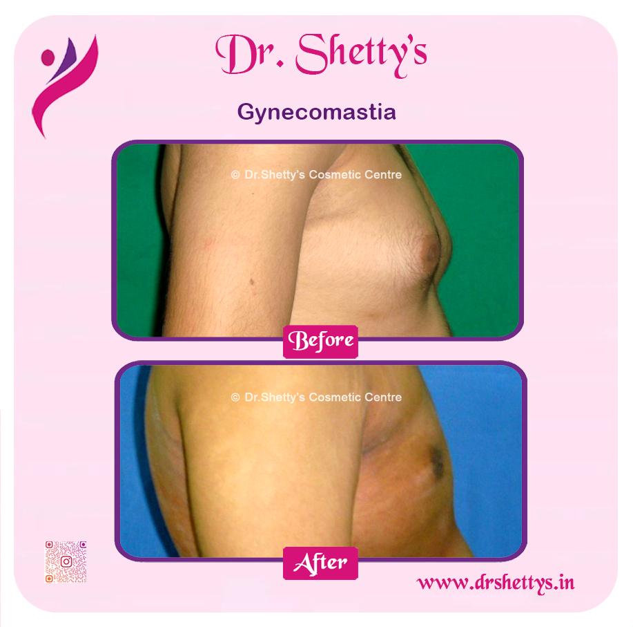 Gynecomastia Surgery Male Breast Reduction 1