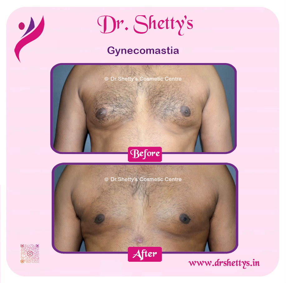 Gynecomastia Surgery Male Breast Reduction 10