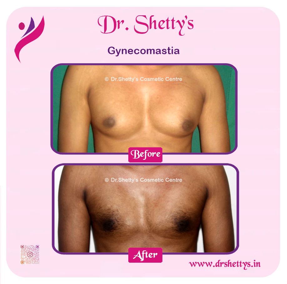 Gynecomastia Surgery Male Breast Reduction 13