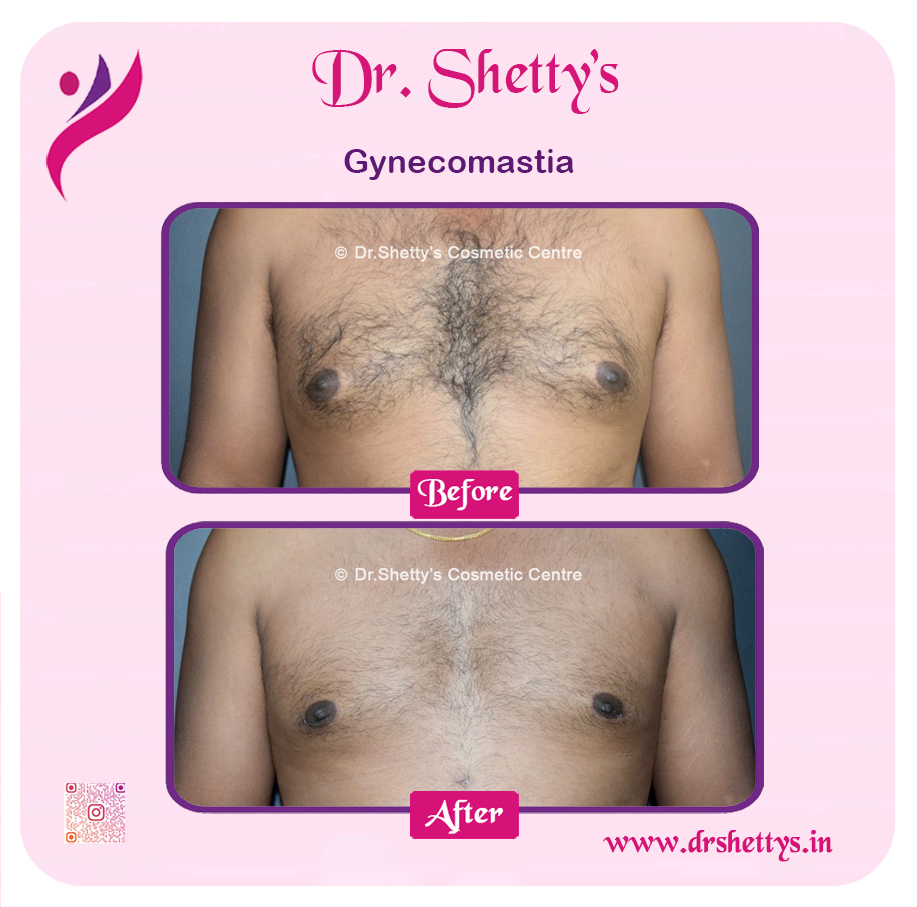 Gynecomastia Surgery Male Breast Reduction 14