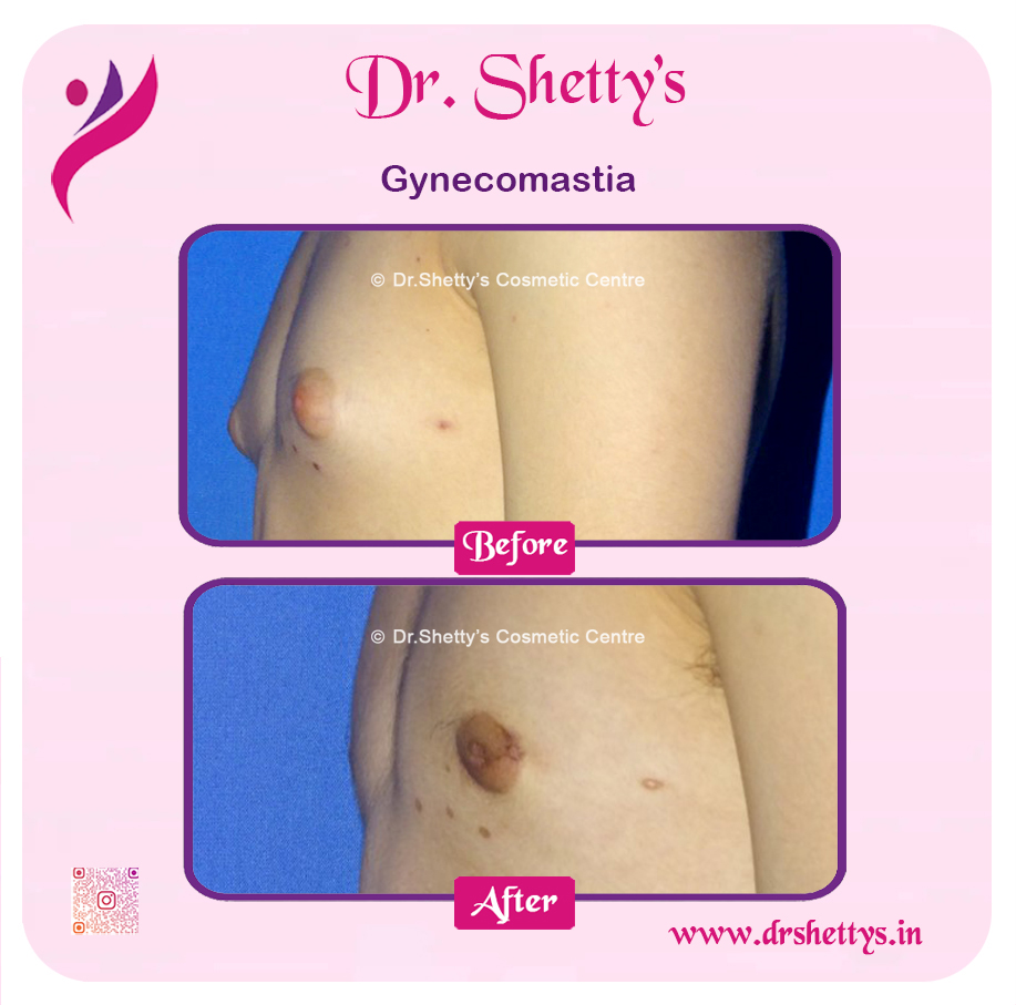 Gynecomastia Surgery Male Breast Reduction 15