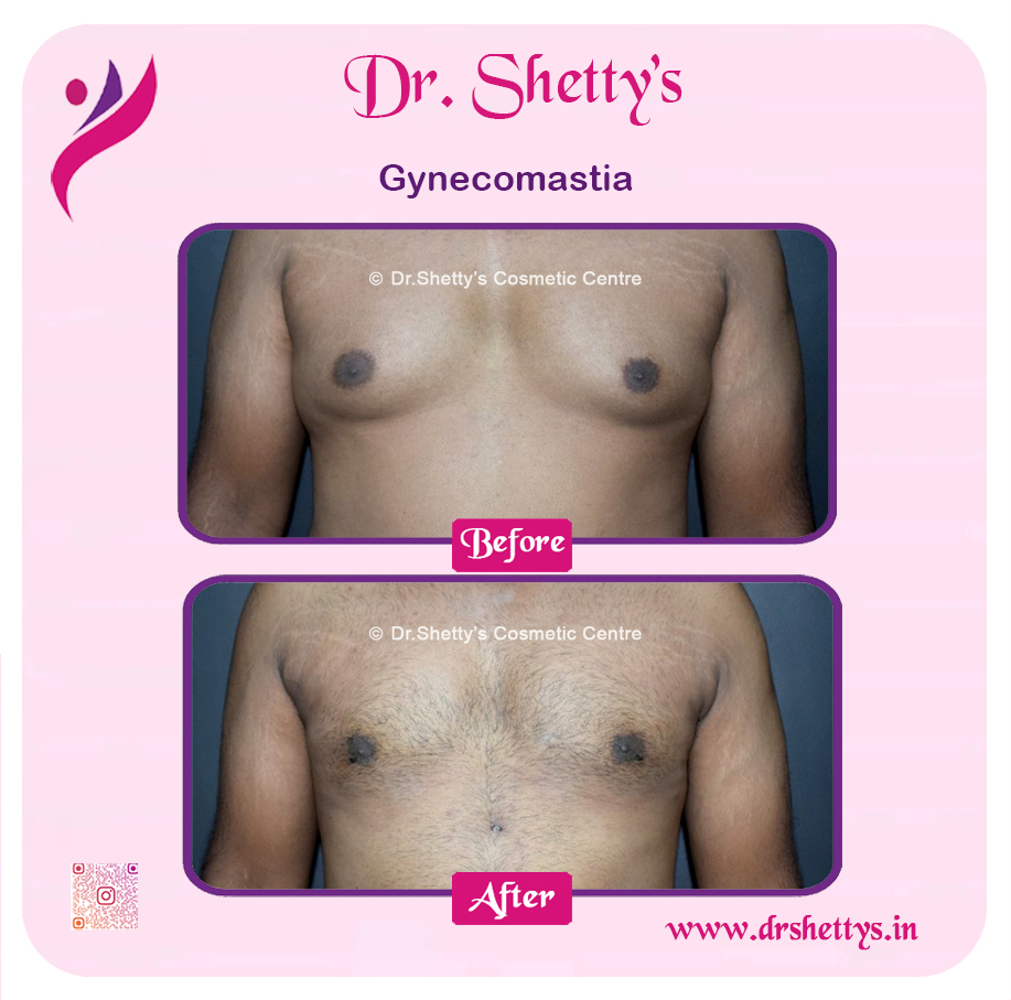 Gynecomastia Surgery Male Breast Reduction 16