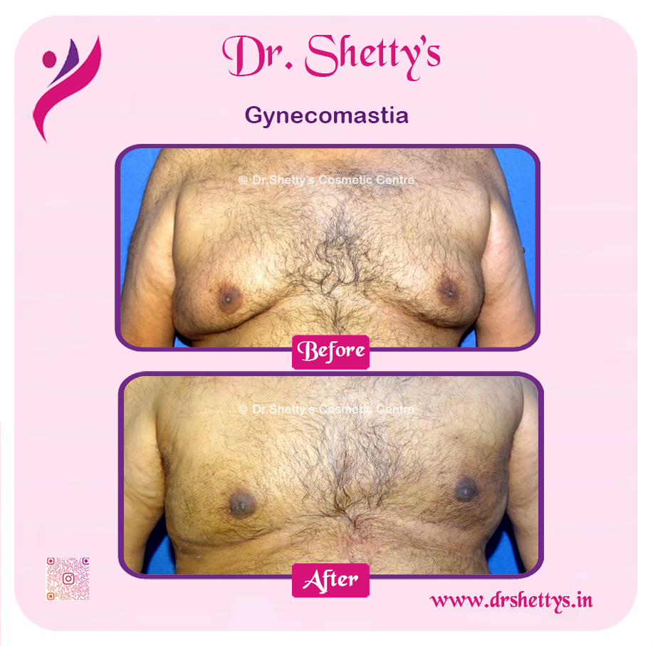 Gynecomastia Surgery Male Breast Reduction 17