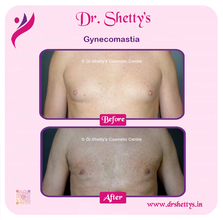 Gynecomastia Surgery Male Breast Reduction 18