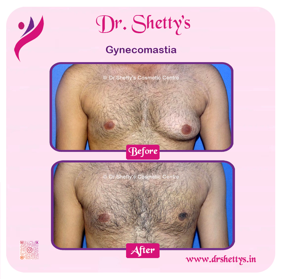 Gynecomastia Surgery Male Breast Reduction 2