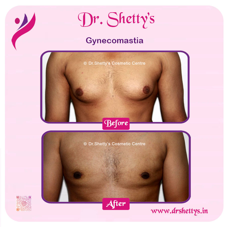 Gynecomastia Surgery Male Breast Reduction 20