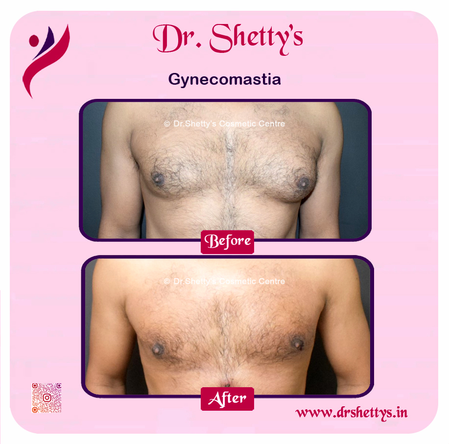 Gynecomastia Surgery Male Breast Reduction 24