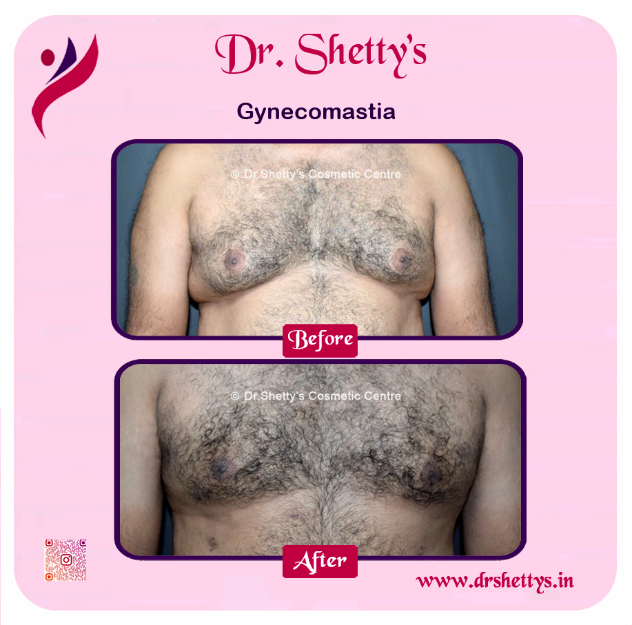 Gynecomastia Surgery Male Breast Reduction 25