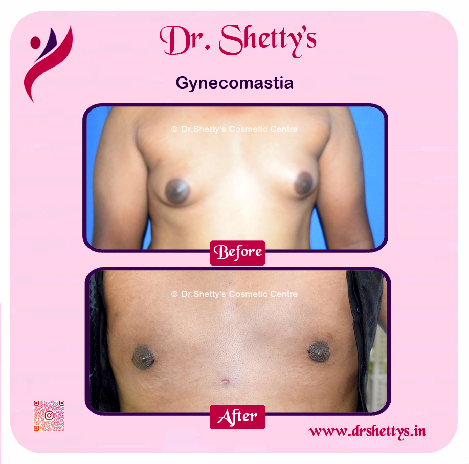 Gynecomastia Surgery Male Breast Reduction 27
