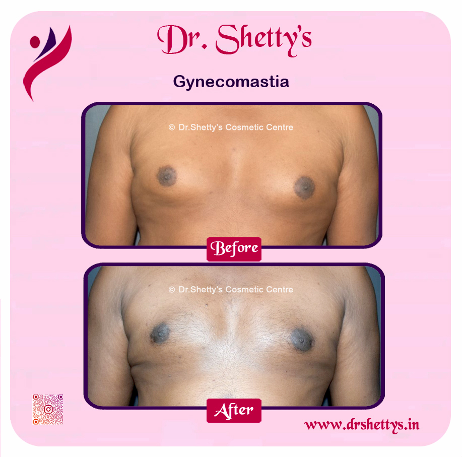 Gynecomastia Surgery Male Breast Reduction 28