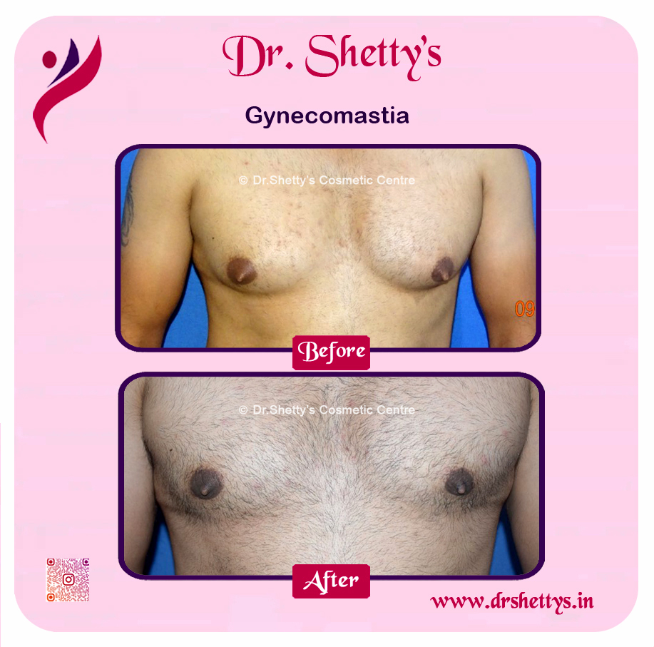 Gynecomastia Surgery Male Breast Reduction 29