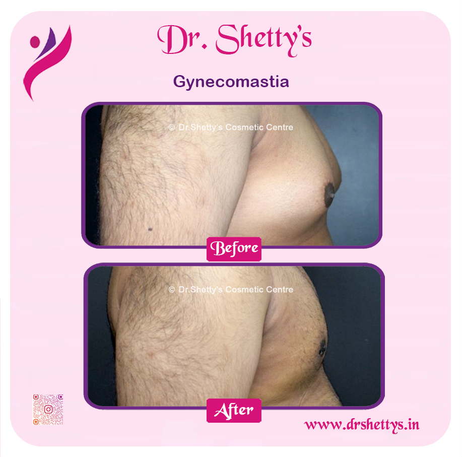 Gynecomastia Surgery Male Breast Reduction 3
